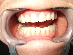 , Dental Veneers in Reading, Berkshire