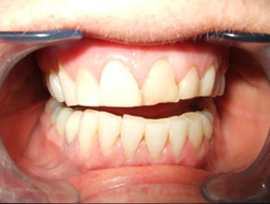 , Dental Veneers in Reading, Berkshire