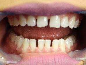, Composite White Fillings in Reading