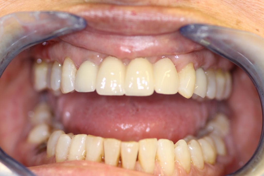 After picture of dental implants procedure by Markham Associates dentist reading