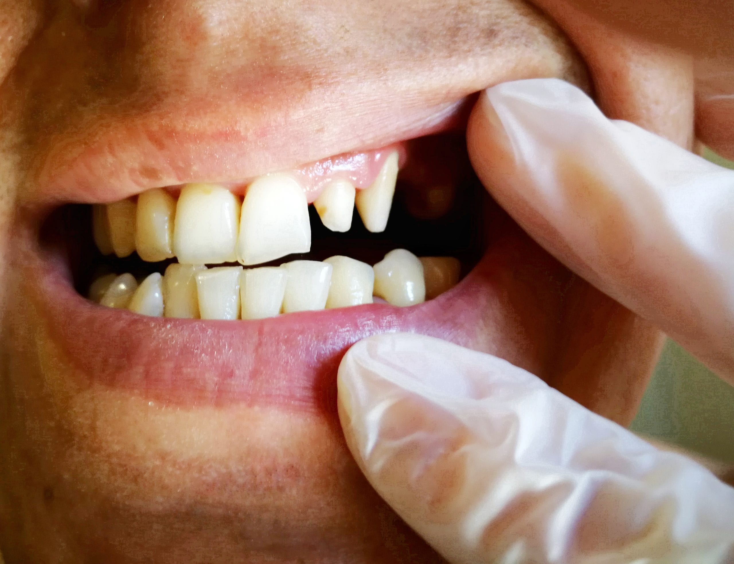 A zoomed in view of a Dentist is examining a patients mouth, showing slightly uneven teeth