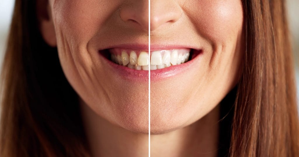 Image of before and after professional teeth whitening procedure