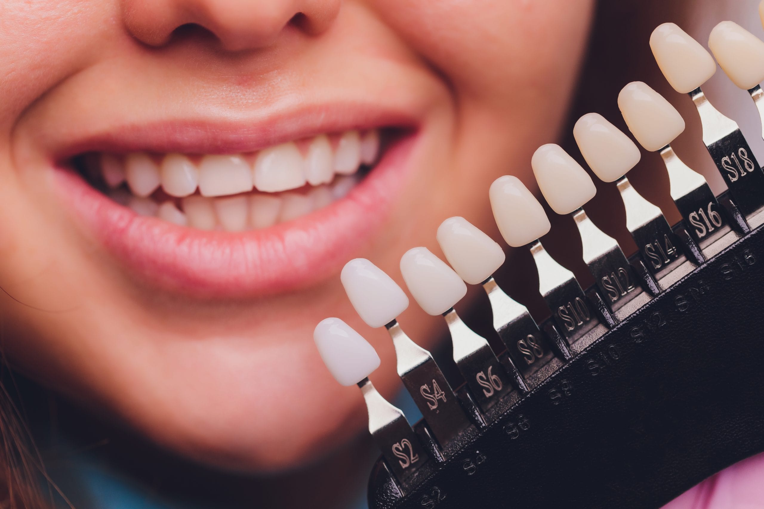 Teeth whitening process discussing shades of teeth