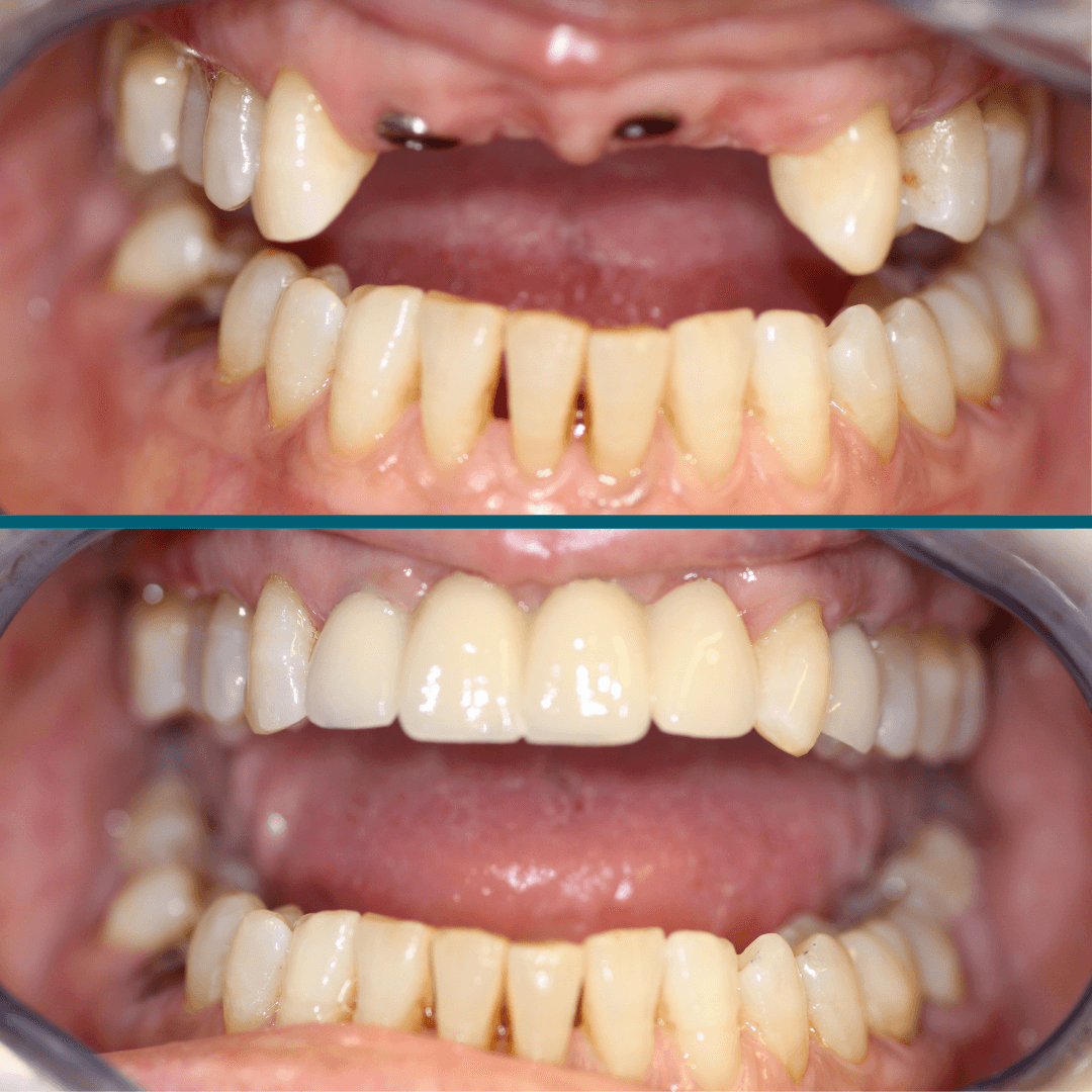 Reading dental implant before and after