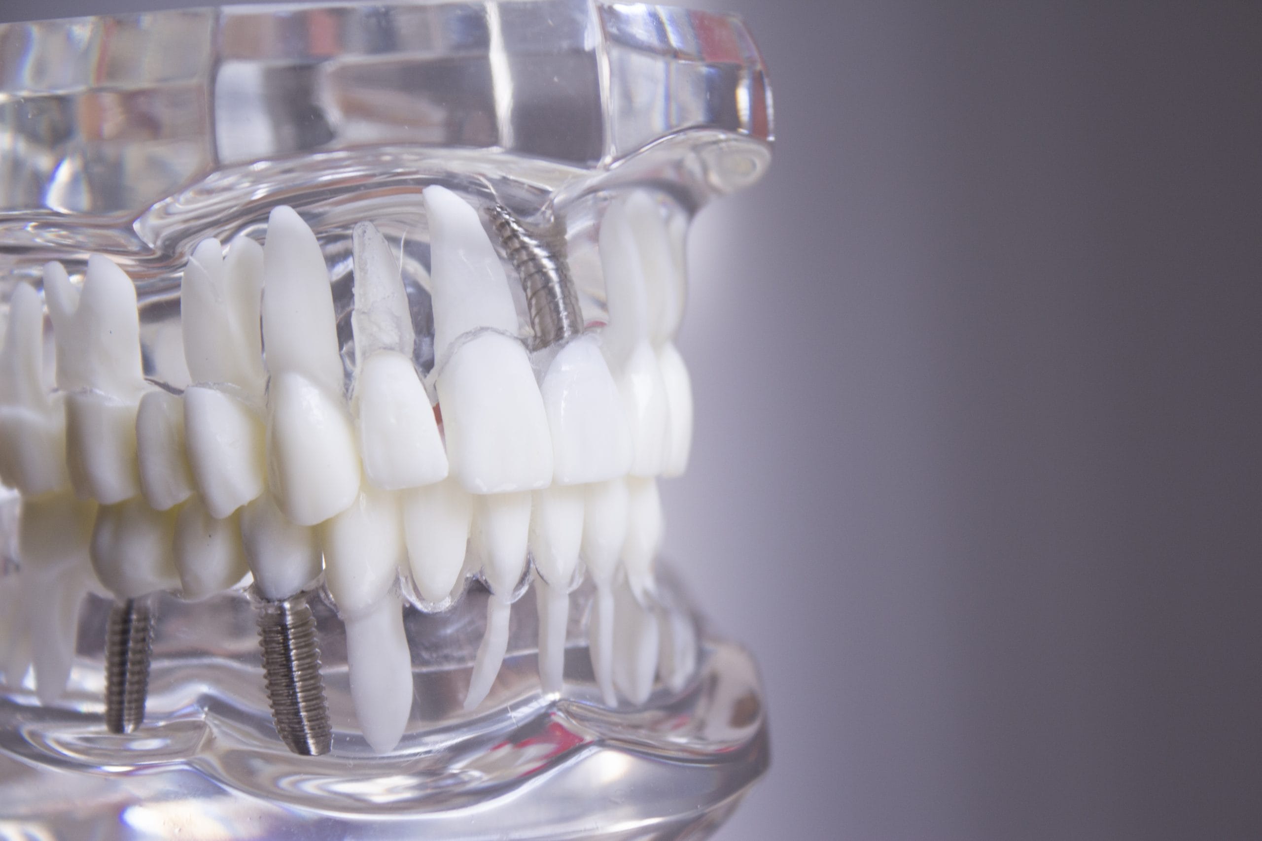 All-on-4 dental implants Reading