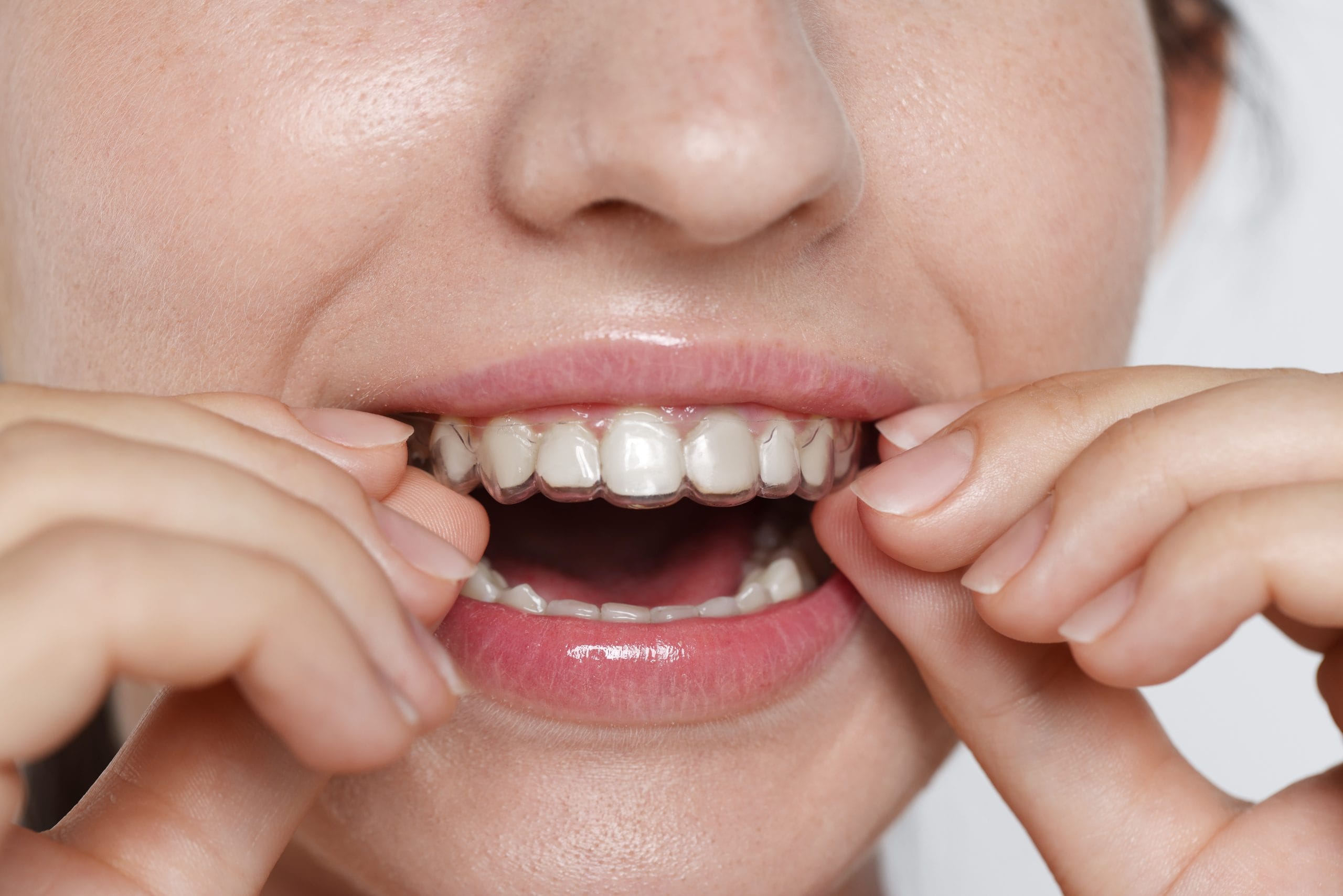 Woman wearing dental aligner on grey background, closeup